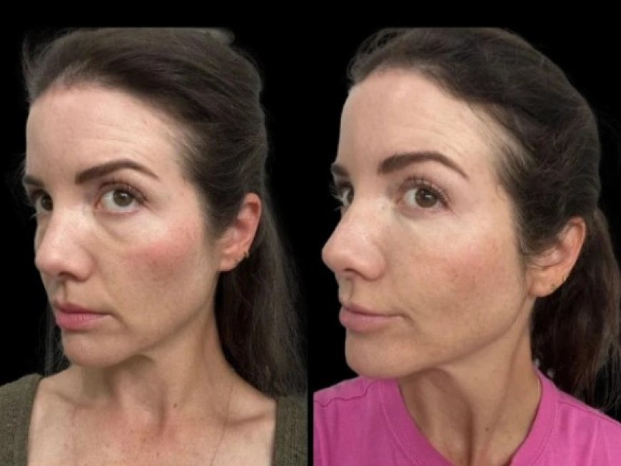 How the Best Doctors in Dubai Tailor Dark Circles Treatments to Skin Type