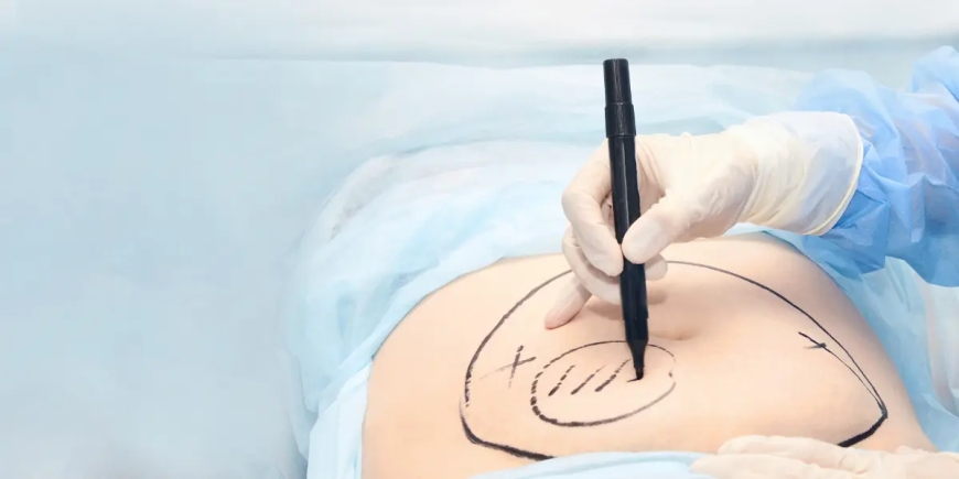 The Benefits of Abdominoplasty in Dubai: Why It’s More Than Just Cosmetic Surgery