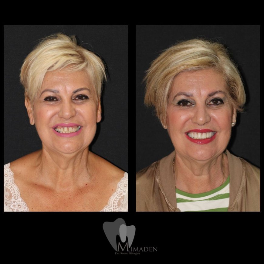 Implante Dental en Hospitalet de Llobregat Recupera tu Sonrisa
