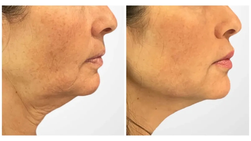 Is Thread Lift in Dubai Worth It? Pros, Cons, and Real Results