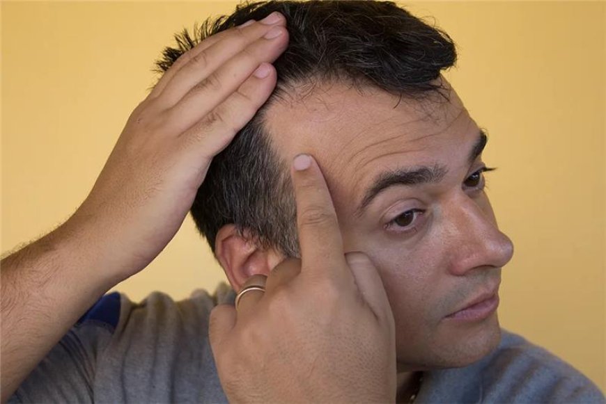 Can Hairline Be Regrown Through FUE Hair Transplant