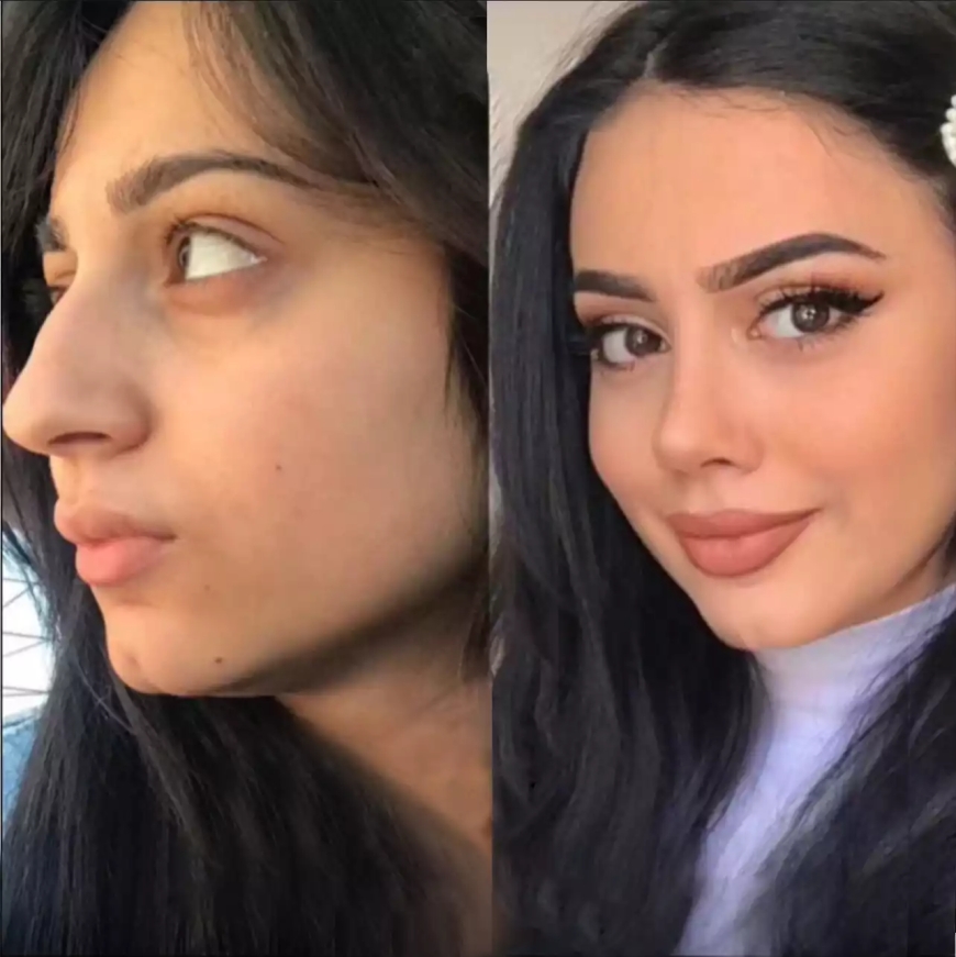 Rhinoplasty Treatment Options in Dubai: Which One Is Right for You?