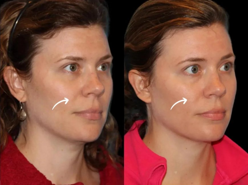 The Psychology of Sculptra Fillers: Best Plastic Surgeons in Dubai Insights