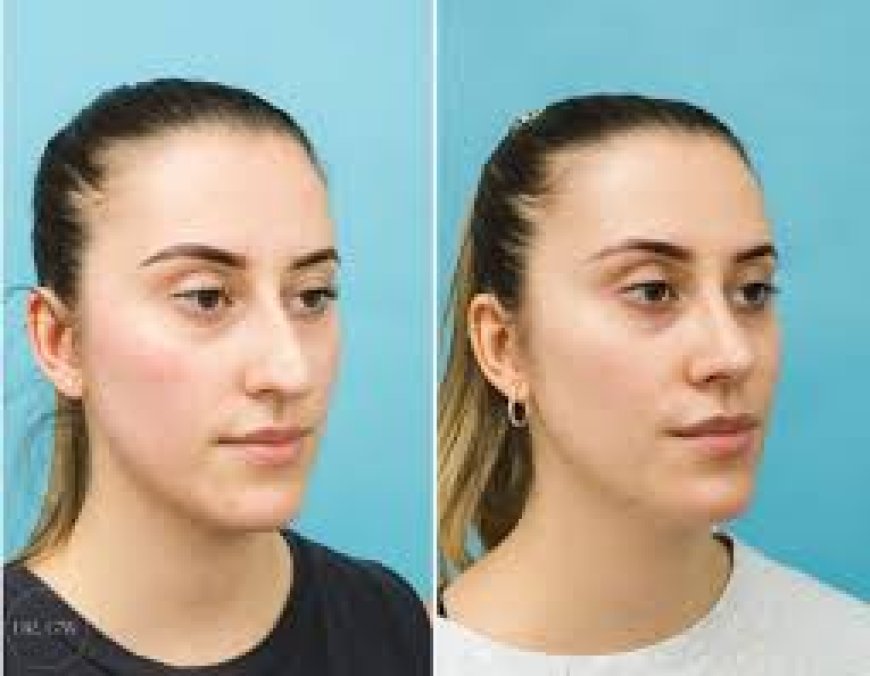 Beyond the Mirror: The Aesthetic and Functional Wonders of Rhinoplasty